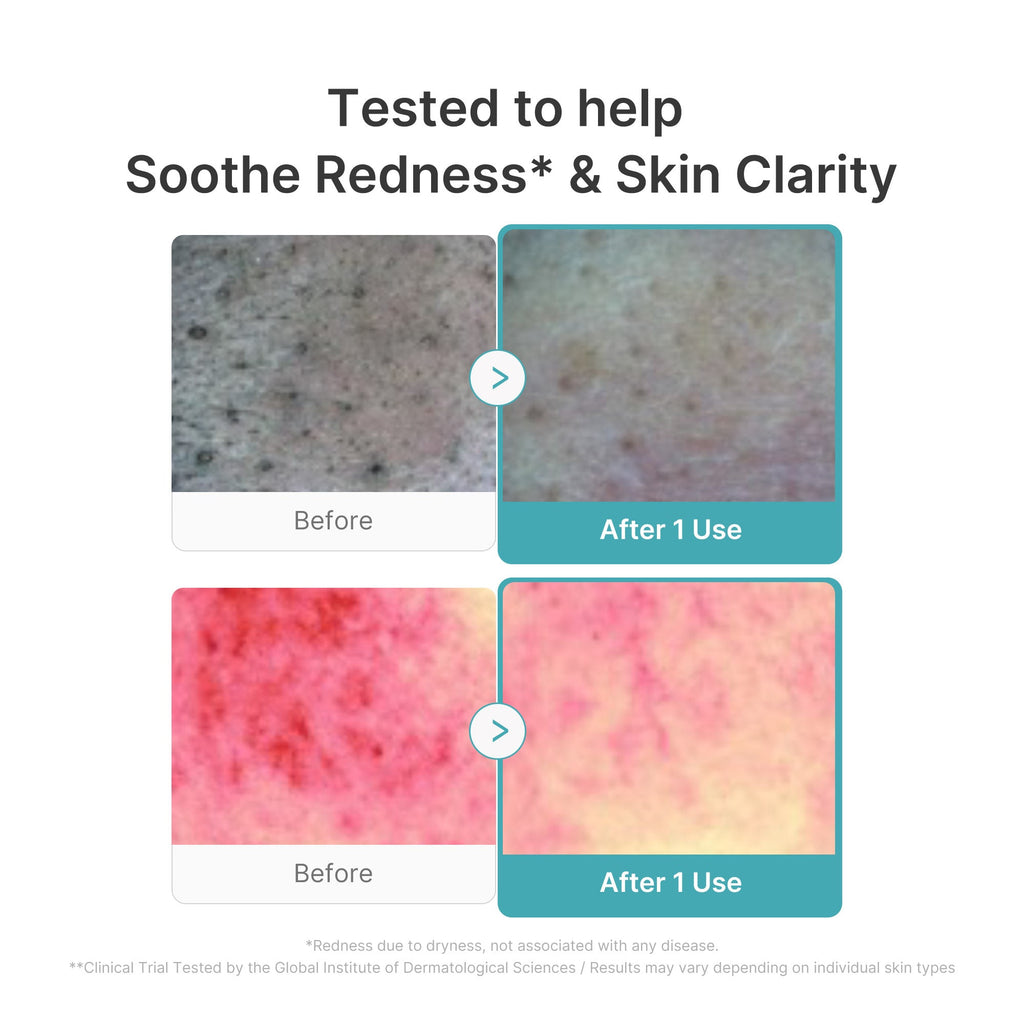 Azelaic Acid Capsule Foam Cleanser - Skincare for Real Life